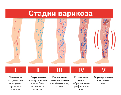 vodka comprima pe picior în varicoza posibil cu venele varicoase elastice bandaj
