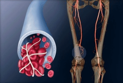 Профилактика тромбоза в венах на ногах: что важно знать