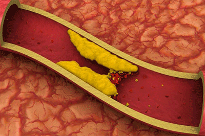 tromboflebit glubokih ven nijnih konechnostey simptomy lechenie