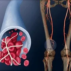 Профилактика образования тромбов в венах на ногах: что важно знать