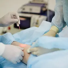 Лазер вместо скальпеля: лечение варикоза без операции